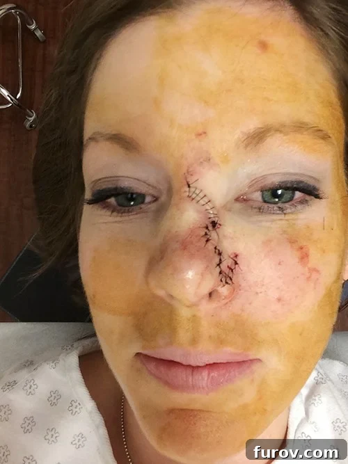 My Face's Transformation A Personal Account 3 A woman's face immediately after nose surgery, with visible stitches, swelling, and iodine stains on her nose and upper cheek.