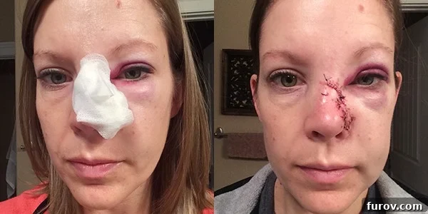 My Face's Transformation A Personal Account 5 A close-up of a woman's nose and eye area, showing significant bruising, swelling, and stitches along the side of her nose.