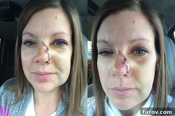 My Face's Transformation A Personal Account 7 Two side-by-side pictures of a woman with distinct bruising and visible stitches on her nose, showing the recovery process.