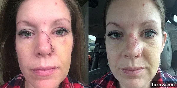My Face's Transformation A Personal Account 8 Two side-by-side pictures of a woman after stitches removal, revealing a more defined scar on her nose and subtle facial asymmetry.