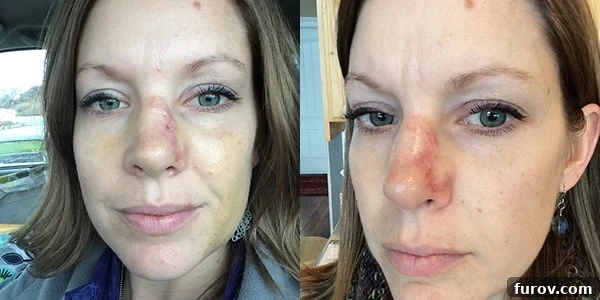 My Face's Transformation A Personal Account 9 Two side-by-side pictures of a woman with a healing scar on her nose, showing a reduction in redness and swelling over time.