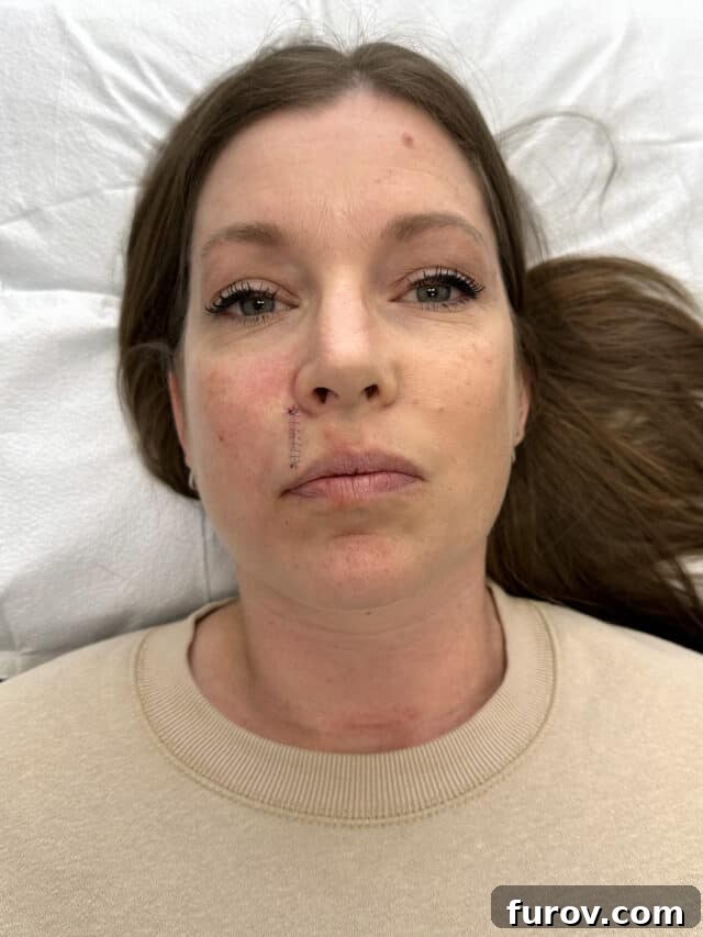 A candid photo of a woman after MOHS surgery, showing a small area on her upper lip with eight stitches, demonstrating the immediate post-operative appearance.