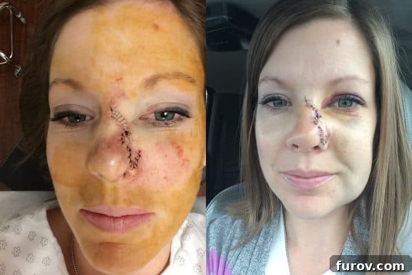 Sun Smart: A Skin Cancer Update & My Favorite Protective Gear 2 Day of surgery and one week after surgery photos showing initial healing